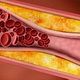 Verstopfte Arterien durch Cholesterin