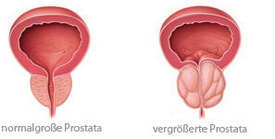 Die vergrößerte Prostata gegenüber der gesunden Prostata